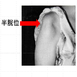 肩關節半脫位